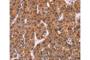 Immunohistochemistry of Human colon cancer using CARD11 Polyclonal Antibody at dilution of 1:40