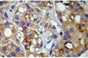 Immunohistochemistry (IHC) analyzes of p-c-RAF (pSer259) pAb in paraffin-embedded human prostate carcinoma tissue. (RAF1 antibody  (pSer259))