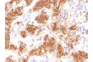 Formalin-fixed, paraffin-embedded human Breast Carcinoma stained with Milk Fat Globule Monoclonal Antibody (SPM291) (MFGE8 antibody)