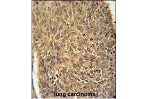 ATG13 Antibody (N-term) (ABIN653882 and ABIN2843129) immunohistochemistry analysis in formalin fixed and paraffin embedded human lung carcinoma followed by peroxidase conjugation of the secondary antibody and DAB staining. (ATG13 antibody  (N-Term))