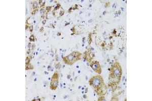 Immunohistochemistry of paraffin-embedded human liver cancer using GATM Antibody (ABIN5973965) at dilution of 1/100 (40x lens). (GATM antibody)