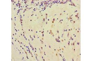 Immunohistochemistry of paraffin-embedded human lung cancer using ABIN7173764 at dilution of 1:100 (TDRD3 antibody  (AA 401-651))