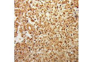 Immunohistochemistry of paraffin-embedded Osteosarcoma using FGF2 antibody. (FGF2 antibody  (AA 143-288))