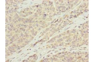 Immunohistochemistry of paraffin-embedded human ovarian cancer using ABIN7145848 at dilution of 1:100 (KCTD19 antibody  (AA 490-751))
