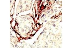 IHC analysis of FFPE human breast carcinoma tissue stained with the LKB1 antibody