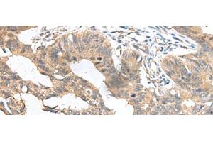 Immunohistochemistry of paraffin-embedded Human colorectal cancer tissue using MIA Polyclonal Antibody at dilution of 1:100(x200)