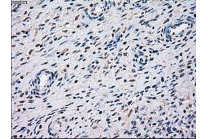 Immunohistochemical staining of paraffin-embedded Adenocarcinoma of breast tissue using anti-STK3 mouse monoclonal antibody. (STK3 antibody)