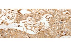 Immunohistochemistry of paraffin-embedded Human esophagus cancer tissue using VMA21 Polyclonal Antibody at dilution of 1:150(x200) (VMA21 antibody)