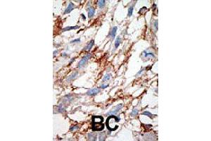Formalin-fixed and paraffin-embedded human cancer tissue reacted with ISG15 polyclonal antibody  , which was peroxidase-conjugated to the secondary antibody, followed by DAB staining.