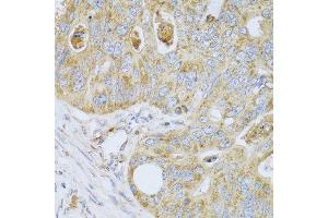 Immunohistochemistry of paraffin-embedded human colon carcinoma using PSG1 antibody at dilution of 1:100 (40x lens). (PSG1 antibody)