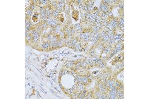 Immunohistochemistry of paraffin-embedded human colon carcinoma using PSG1 antibody at dilution of 1:100 (40x lens).