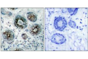 Immunohistochemical analysis of paraffin-embedded human breast carcinoma tissue using GAP43(Ab-41) Antibody(left) or the same antibody preincubated with blocking peptide(right).