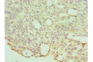 Immunohistochemistry of paraffin-embedded human endommetrial cancer using ABIN7155970 at dilution of 1:100
