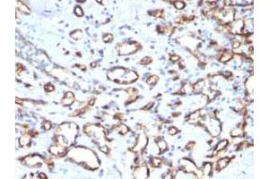 Immunohistochemical staining (Formalin-fixed paraffin-embedded sections) of human angiosarcoma with CD34 monoclonal antibody, clone SPM610 . (CD34 antibody)