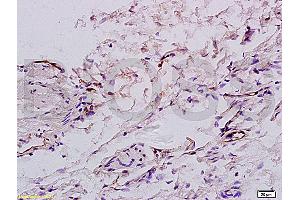 Formalin-fixed and paraffin embedded:human colon carcinoma labeled with Anti-factor VIII(FVIII) (human) Polyclonal Antibody (ABIN728000), Unconjugated at 1:200, followed by conjugation to the secondary antibody and DAB staining (Factor VIII antibody  (AA 1451-1550))