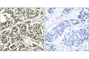 Immunohistochemistry analysis of paraffin-embedded human breast carcinoma tissue, using BRCA1 (Ab-1524) Antibody. (BRCA1 antibody  (AA 1491-1540))