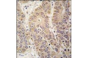 Formalin-fixed and paraffin-embedded human hepatocarcinoma tissue reacted with HARS antibody (N-term), which was peroxidase-conjugated to the secondary antibody, followed by DAB staining. (HARS1/Jo-1 antibody  (N-Term))