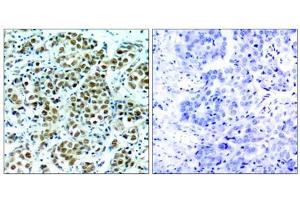 Immunohistochemical analysis of paraffin-embedded human breast carcinoma tissue, using p90RSK (phospho-Thr348) antibody (E011105). (RPS6KA3 antibody  (pThr348))