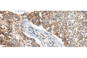 Immunohistochemistry of paraffin-embedded Human lung cancer tissue using BBS12 Polyclonal Antibody at dilution of 1:50(x200) (BBS12 antibody)