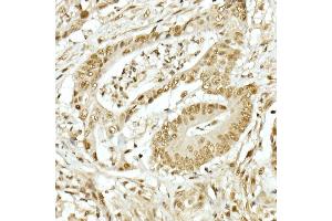 Immunohistochemistry of paraffin-embedded human colon carcinoma using TOPBP1 Rabbit pAb (ABIN6129493, ABIN6149398, ABIN6149401 and ABIN6221465) at dilution of 1:50 (40x lens). (TOPBP1 antibody  (AA 1253-1522))