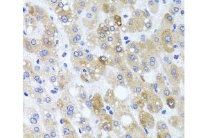 Immunohistochemistry of paraffin-embedded Human liver damage using ATP7A Polyclonal Antibody at dilution of 1:100 (40x lens). (ATP7A antibody)