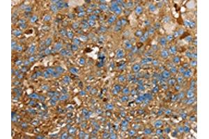 The image on the left is immunohistochemistry of paraffin-embedded Human breast cancer tissue using ABIN7130083(LGALS3BP Antibody) at dilution 1/25, on the right is treated with fusion protein.