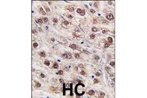 Formalin-fixed and paraffin-embedded human hepatocarcinoma tissue reacted with JMJD4 (C-term) (ABIN387875 and ABIN2844081) , which was peroxidase-conjugated to the secondary antibody, followed by DAB staining. (JMJD4 antibody  (C-Term))