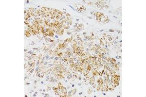Immunohistochemistry of paraffin-embedded human prostate cancer using MYO5A antibody (ABIN6003562) at dilution of 1/100 (40x lens). (MYO5A antibody)