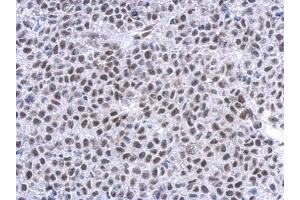 IHC-P Image Immunohistochemical analysis of paraffin-embedded Hela xenograft, using Glucocorticoid receptor, antibody at 1:500 dilution. (Glucocorticoid Receptor antibody  (N-Term))