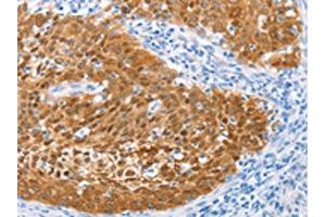 The image on the left is immunohistochemistry of paraffin-embedded Human cervical cancer tissue using ABIN7129916(IRF6 Antibody) at dilution 1/50, on the right is treated with fusion protein. (IRF6 antibody)