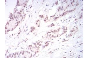 Immunohistochemical analysis of paraffin-embedded colon cancer tissues using DNMT3B mouse mAb with DAB staining. (DNMT3B antibody  (AA 1-150))