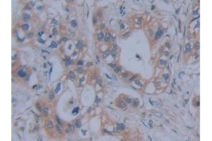 Detection of FBN1 in Human Pancreatic cancer Tissue using Polyclonal Antibody to Fibrillin 1 (FBN1) (Fibrillin 1 antibody  (AA 246-389))