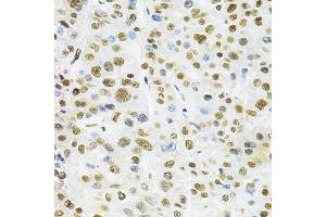 Immunohistochemistry of paraffin-embedded human liver cancer using B/B/SM Antibody  at dilution of 1:200 (40x lens). (SMARCE1 antibody  (AA 1-411))