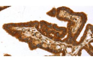 Immunohistochemistry of paraffin-embedded Human thyroid cancer using TP53I11 Polyclonal Antibody at dilution of 1:40 (TP53I11 antibody)