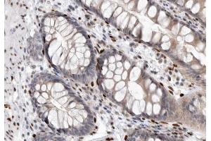 ABIN6267322 at 1/200 staining human colon carcinoma tissue sections by IHC-P.
