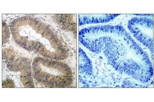 Immunohistochemical analysis of paraffin- embedded human colon carcinoma tissue, using IKKα (phospho-Thr23) antibody (E011129). (IKK alpha antibody  (pThr23))