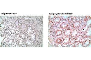 Immunohistochemistry analysis of formalin-fixed, paraffin-embedded human colon tumor tissue stained with Fas polyclonal antibody,  at 10 μg/mL. (FAS antibody)