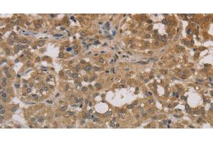 Immunohistochemistry of paraffin-embedded Human thyroid cancer tissue using DEGS1 Polyclonal Antibody at dilution 1:30 (DEGS1 antibody)