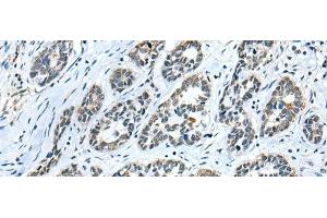 Immunohistochemistry of paraffin-embedded Human esophagus cancer tissue using GMFB Polyclonal Antibody at dilution of 1:25(x200) (GMFB antibody)