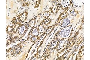ABIN7096023 and ABIN7100085 at 1/100 staining human ovarian cancer by IHC-P. (MAPK1IP1L antibody)