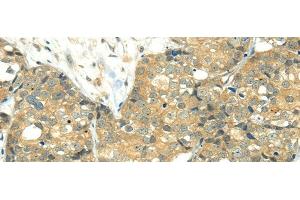 Immunohistochemistry of paraffin-embedded Human breast cancer using TRIM10 Polyclonal Antibody at dilution of 1/35 (TRIM10 antibody)