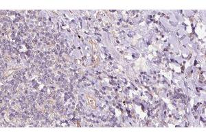 ABIN6273158 at 1/100 staining Human lymph cancer tissue by IHC-P. (SACM1L antibody  (Internal Region))