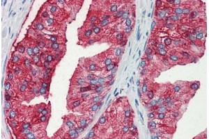 Human Prostate (formalin-fixed, paraffin-embedded) stained with MUC13 antibody ABIN351431 at 10 ug/ul followed by biotinylated goat anti-rabbit IgG secondary antibody ABIN481713, alkaline phosphatase-streptavidin and chromogen. (MUC13 antibody  (Internal Region))