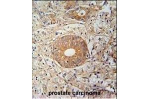 S35E2 Antibody (N-term) (ABIN654754 and ABIN2844438) immunohistochemistry analysis in formalin fixed and paraffin embedded human prostate carcinoma followed by peroxidase conjugation of the secondary antibody and DAB staining. (SLC35E2 antibody  (N-Term))