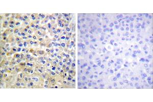 Peptide - +Immunohistochemical analysis of paraffin-embedded human breast carcinoma tissue using EGFR (Ab-678) antibody (#B0008). (EGFR antibody  (Thr678))