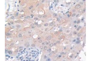 IHC-P analysis of Human Breast Cancer Tissue, with DAB staining. (GAMT antibody  (AA 64-236))
