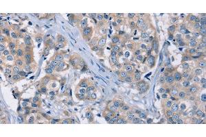 Immunohistochemistry of paraffin-embedded Human breast cancer using KCNQ5 Polyclonal Antibody at dilution of 1:30 (KCNQ5 antibody)