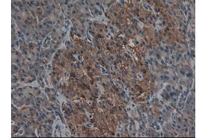 Immunohistochemical staining of paraffin-embedded Carcinoma of kidney using anti-CPA1 (ABIN2452540) mouse monoclonal antibody. (CPA1 antibody  (AA 1-419))
