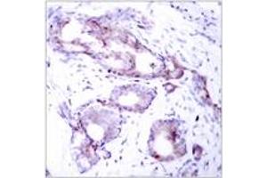 Immunohistochemistry analysis of paraffin-embedded human breast carcinoma, using Myc (Phospho-Ser373) Antibody. (c-MYC antibody  (pSer373))
