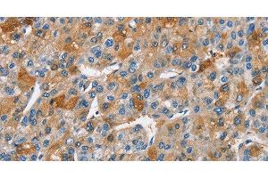 Immunohistochemistry of paraffin-embedded Human liver cancer using BCL10 Polyclonal Antibody at dilution of 1:40 (BCL10 antibody)